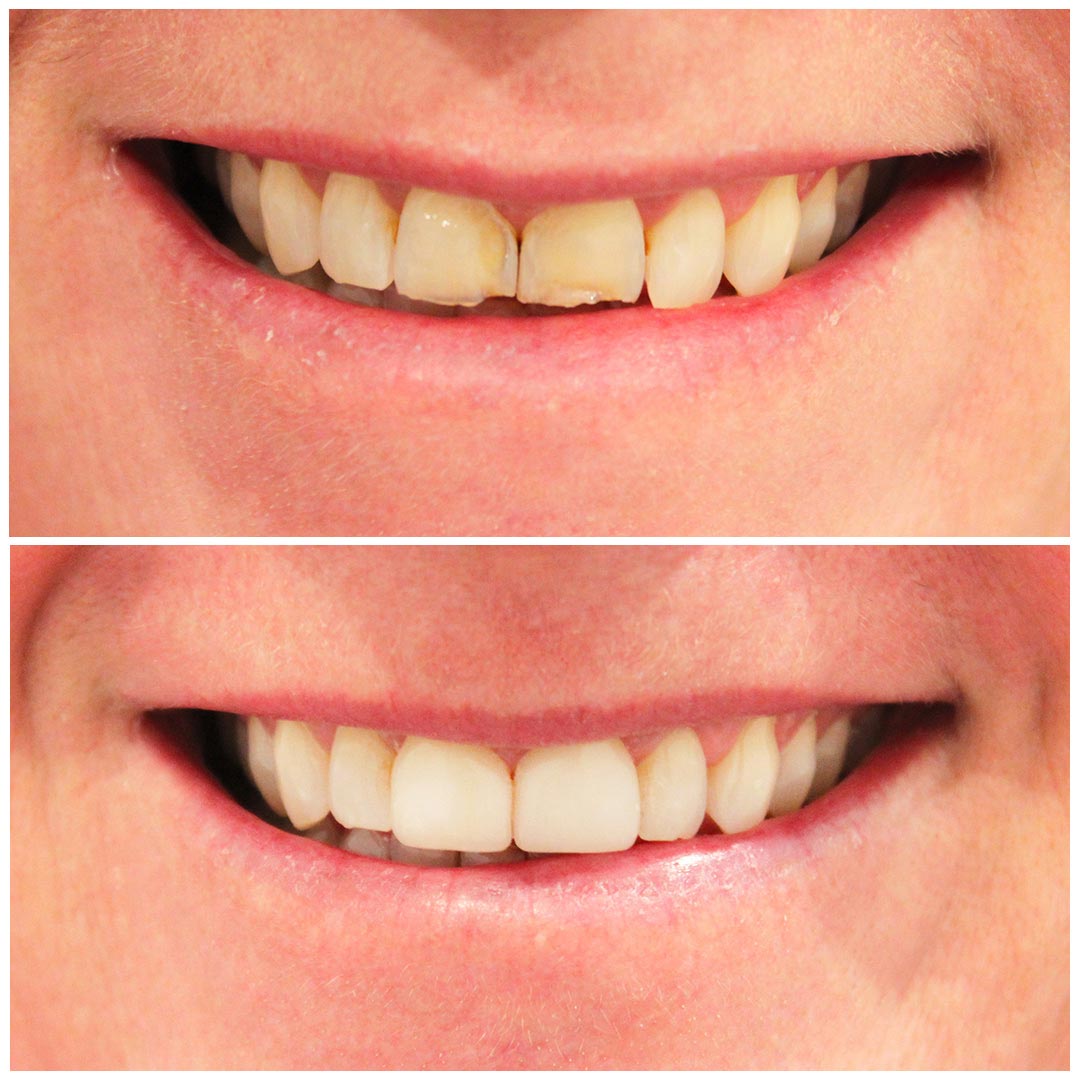 A woman smiling before and after getting her broken teeth fixed