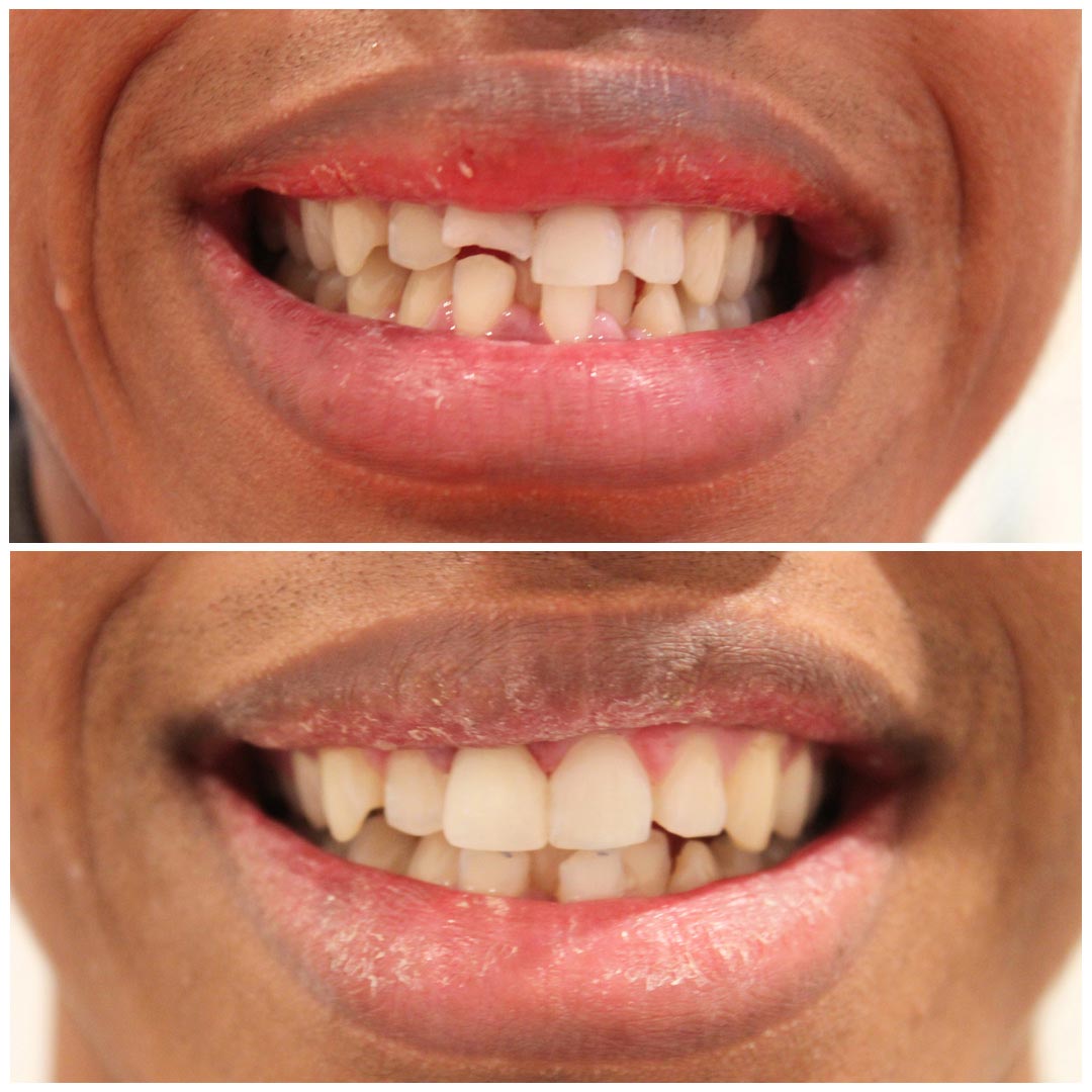 A man smiling before and after getting his broken teeth fixed