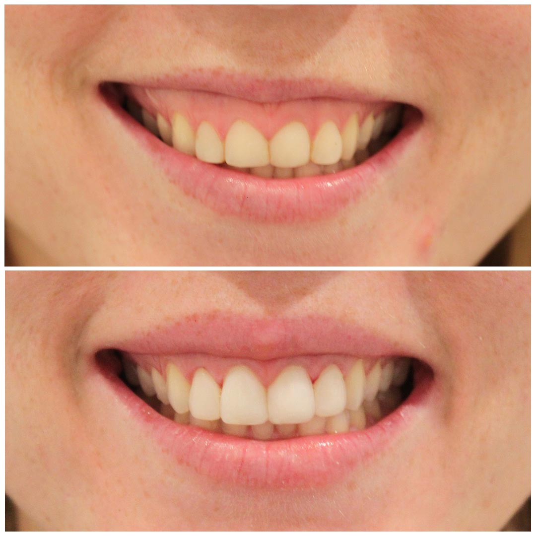 A woman smiling before and after getting a gum lift