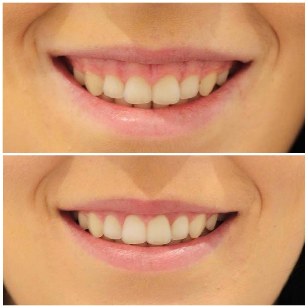 A woman smiling before and after getting a gum lift