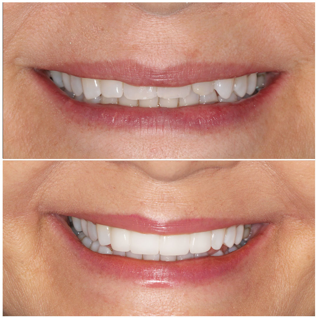 A woman smiling before and after dental tooth bonding