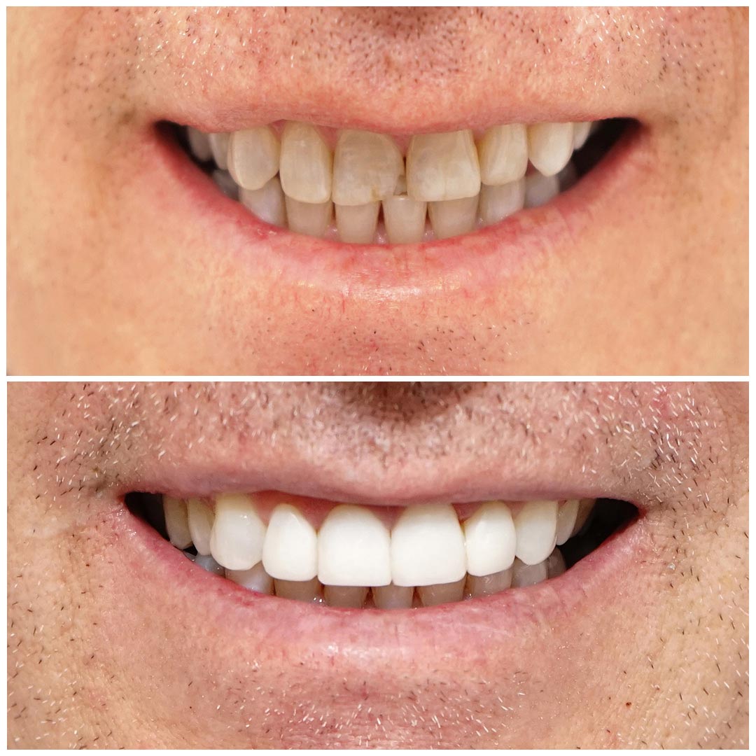A man smiling before and after dental tooth bonding