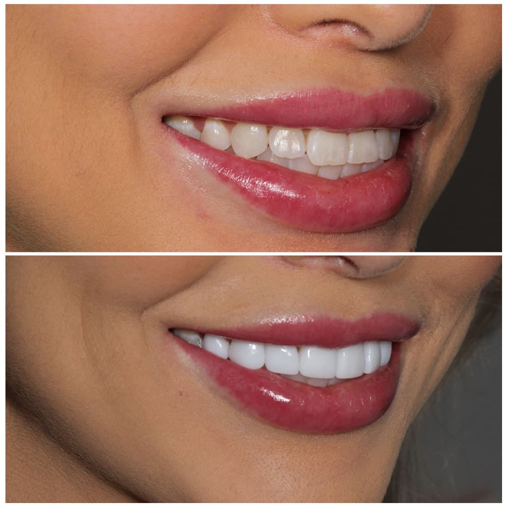 A woman smiling before and after getting porcelain veneers