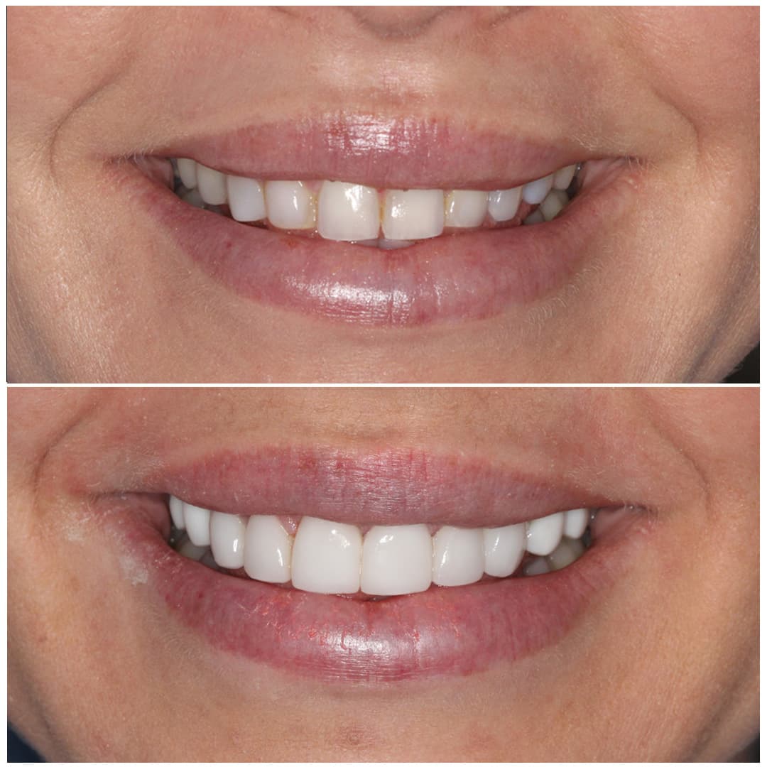 A woman smiling before and after dental tooth bonding